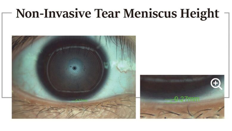 DEA-520 Tear Meniscus Height